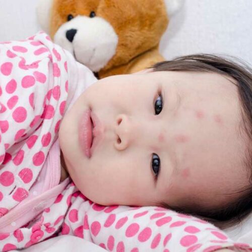 Here’s How to Identify Common Insect Bites