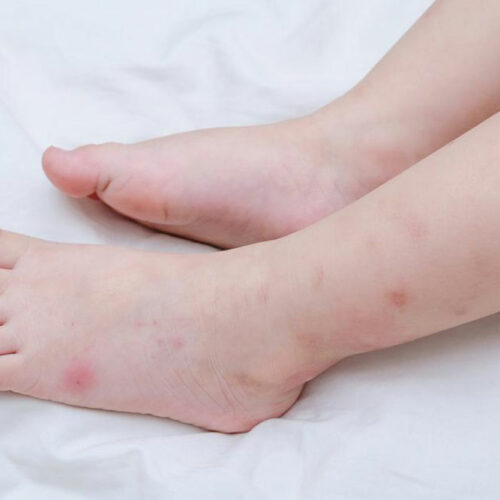 Here’s how to identify insect bites quickly