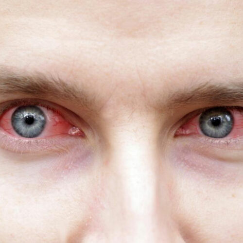 Tips to control the symptoms of Sjogren’s syndrome effectively