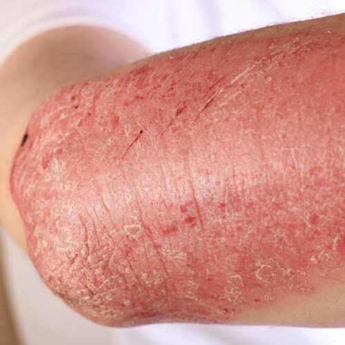 Immune system disorder – Symptoms, causes, and risks