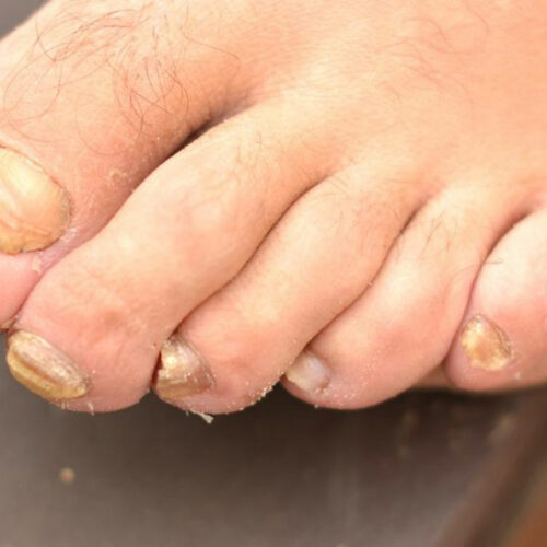 Toenail Fungus – Causes, Symptoms and Treatment